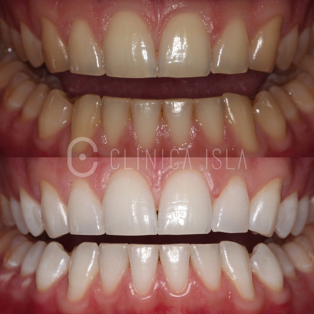 Blanqueamiento Dental