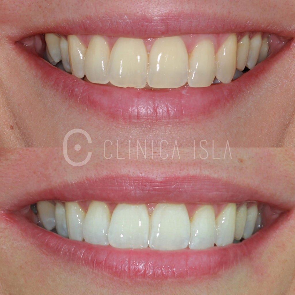 Blanqueamiento Dental