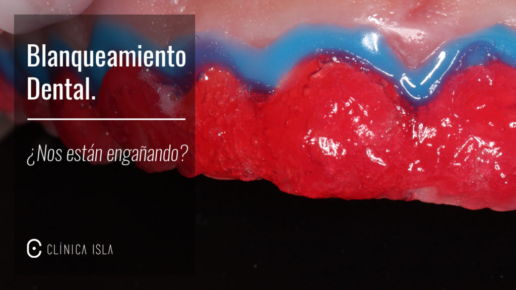 Blanqueamiento Dental.